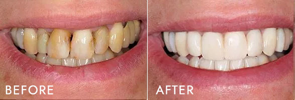 The image shows a side-by-side comparison of a person s teeth before and after dental treatment, highlighting the transformation from yellowed to white teeth.