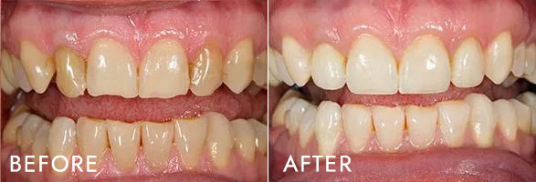 Before and after images of a teeth whitening treatment, showing significant improvement in the brightness and color of the teeth.