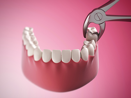 An image of a dental implant being placed into a human mouth, with visible screws and a pink background.